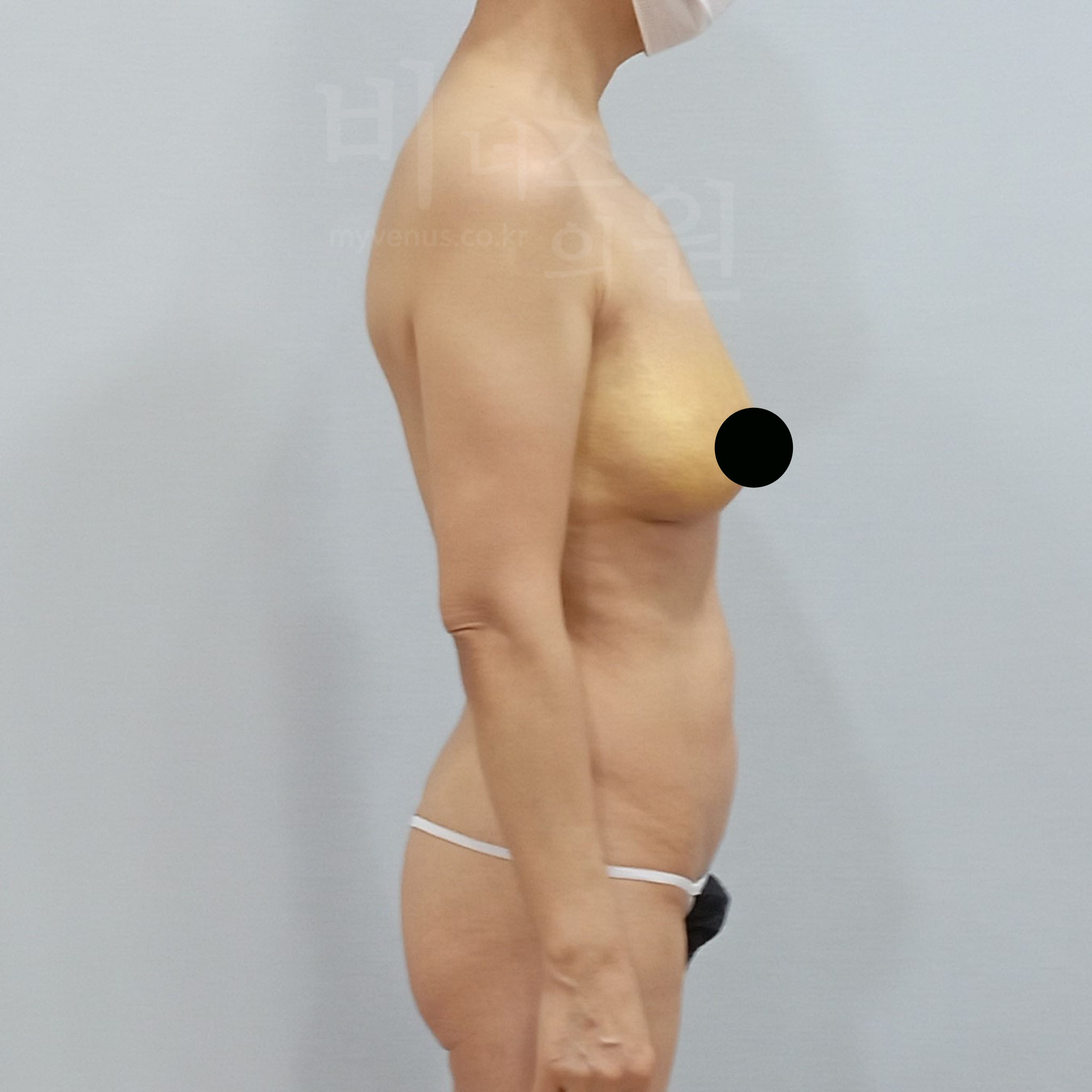 가슴축소 지방흡입 수술 후 측면