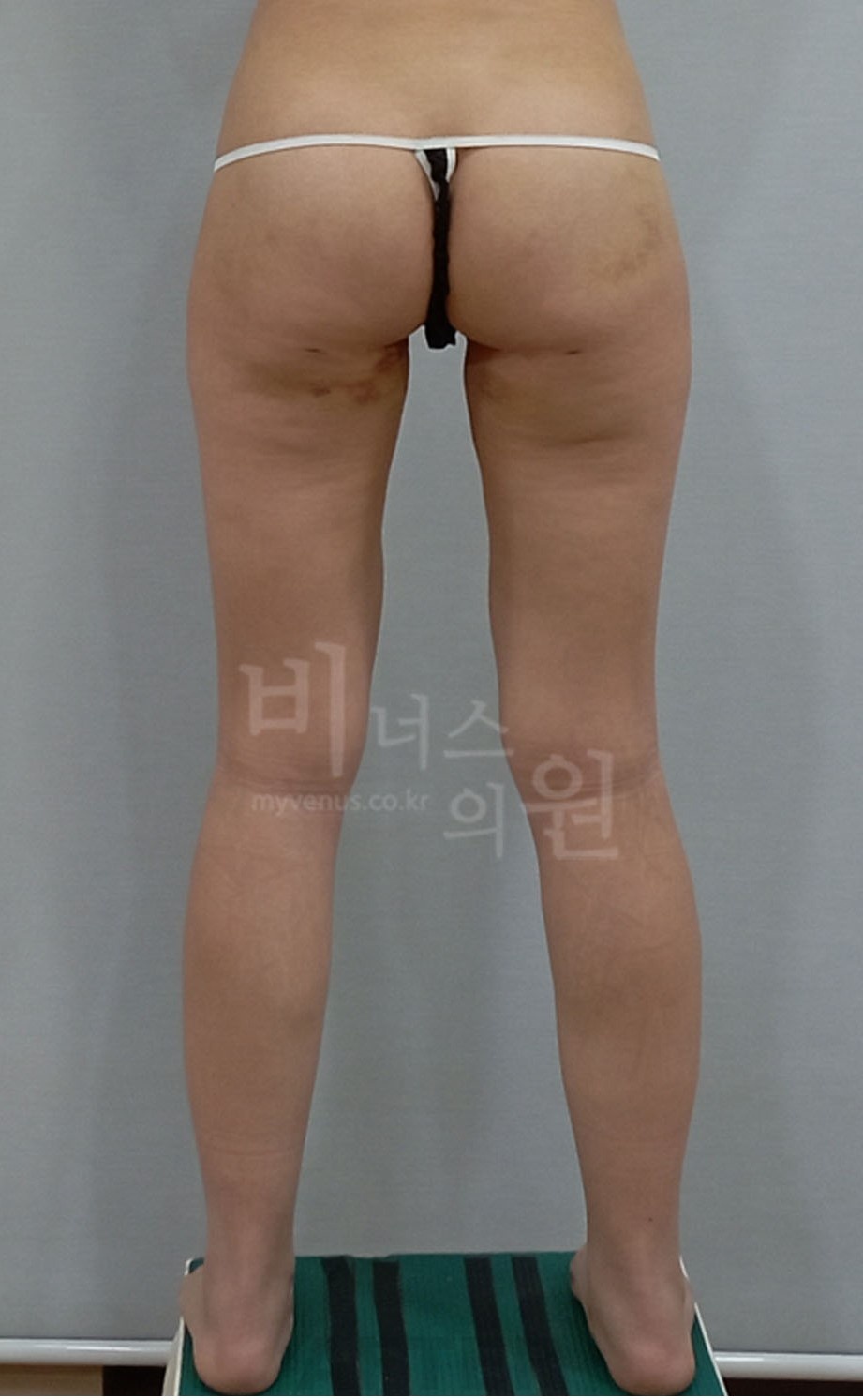 엉덩이 볼륨 변화 비교 시술 후 후면 비너스의원