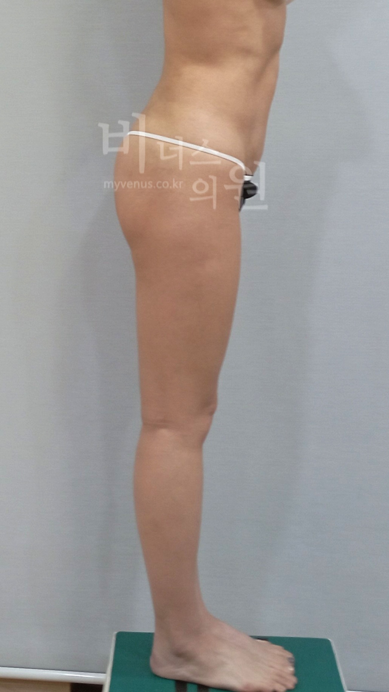 엉덩이 처짐 교정 지방흡입 수술 후 측면(우) 비너스의원
