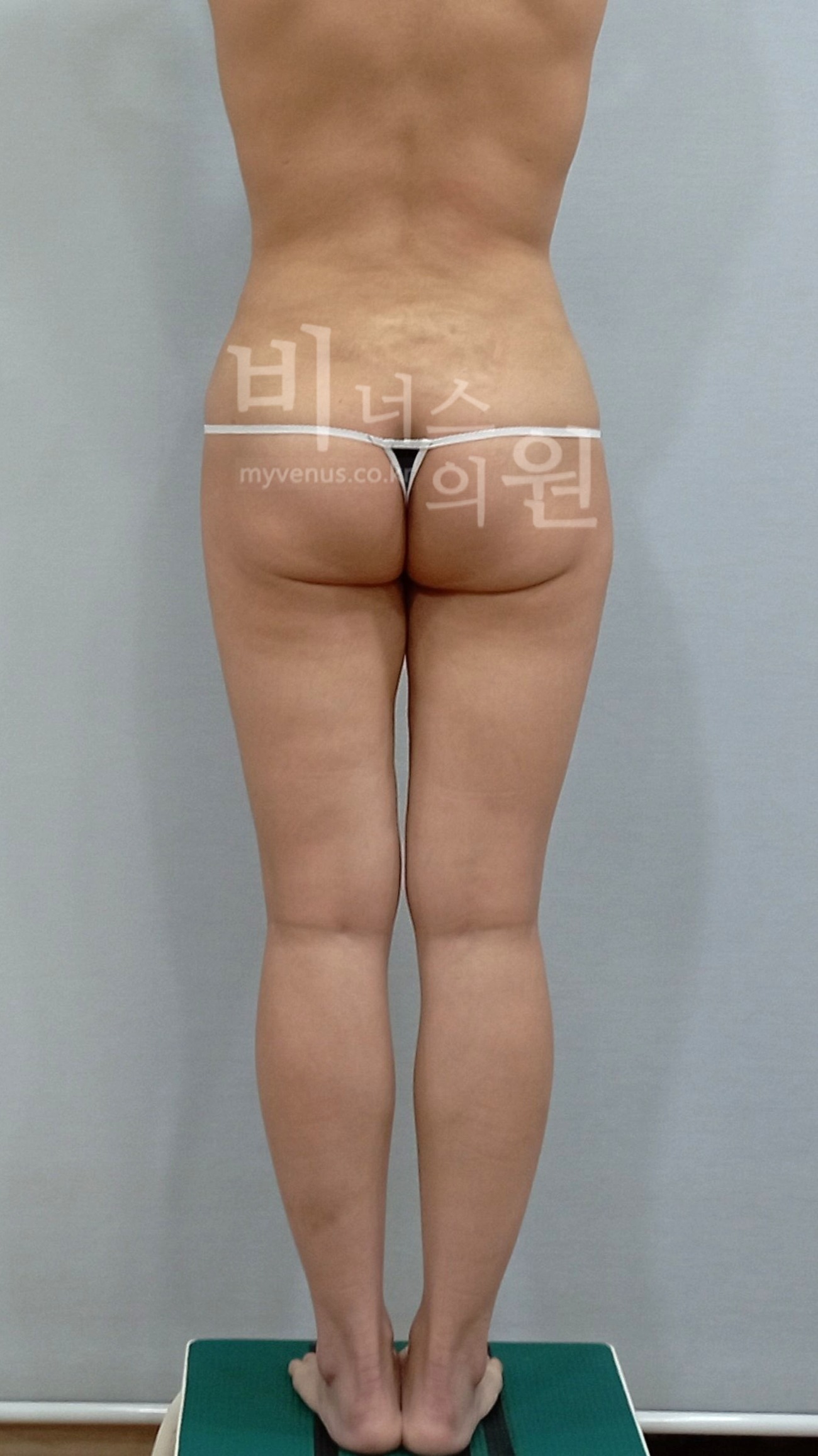 엉덩이 처짐 교정 지방흡입 수술 전 후면 비너스의원