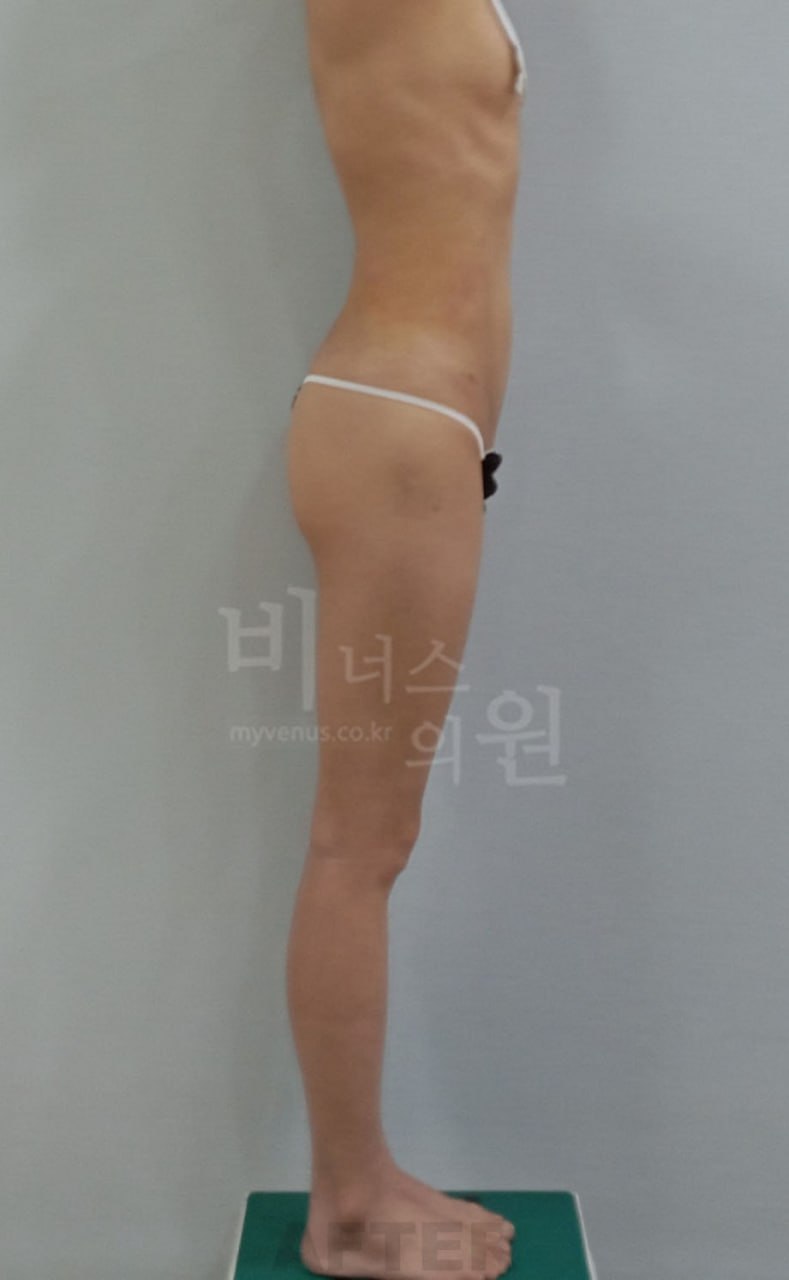 엉덩이 지방흡입 수술 후 측면 비너스의원