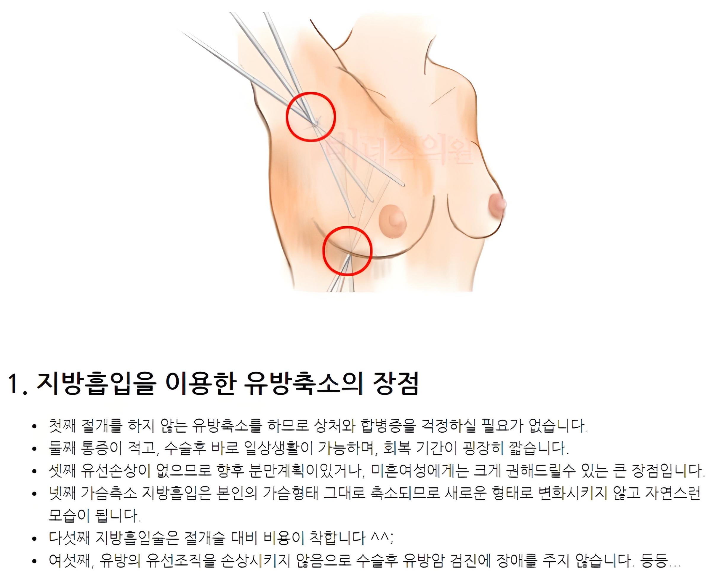 가슴 지방흡입 장점 이미지 자료 — 투메슨트 기법 원리 설명
