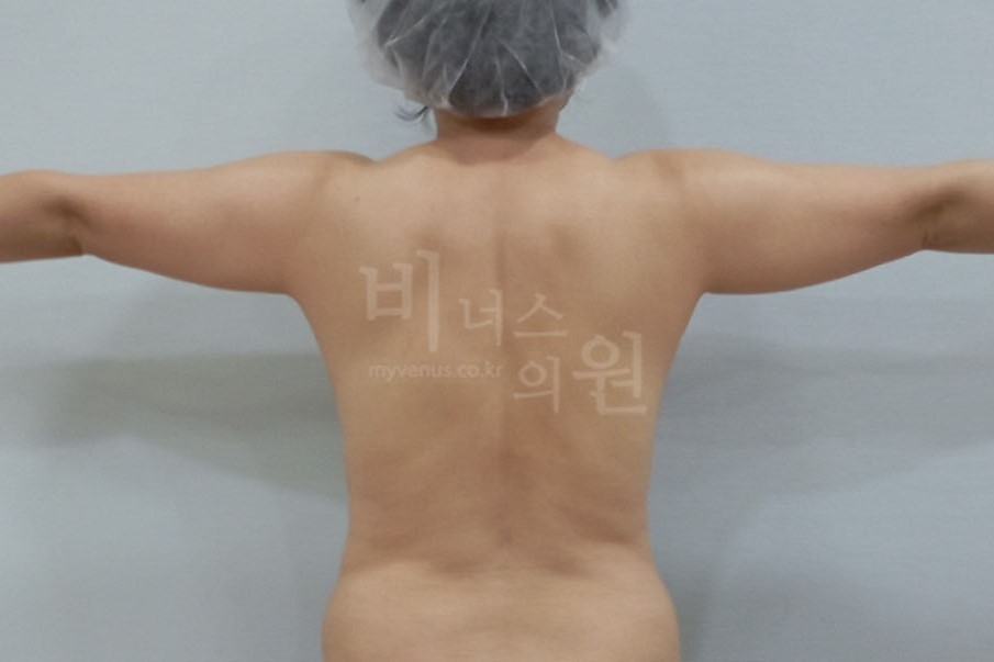 팔지방흡입_4 (2).JPG