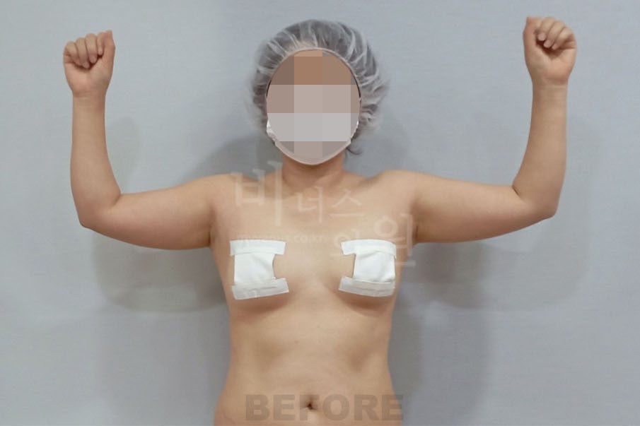 팔지방흡입 (2).JPG