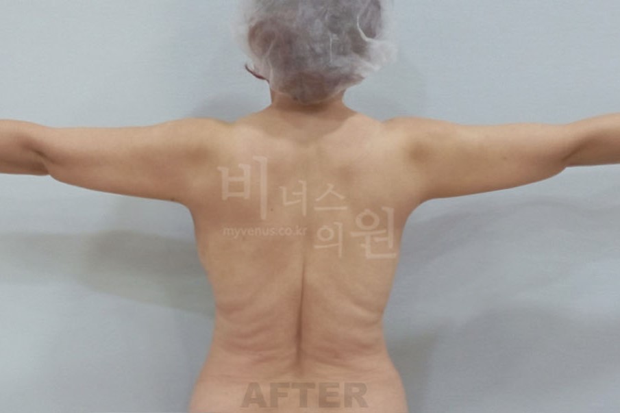 팔뚝살지방흡입_3.jpg