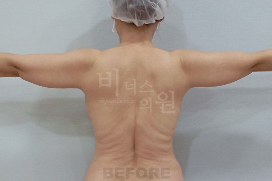 팔뚝살지방흡입_3_3.jpg