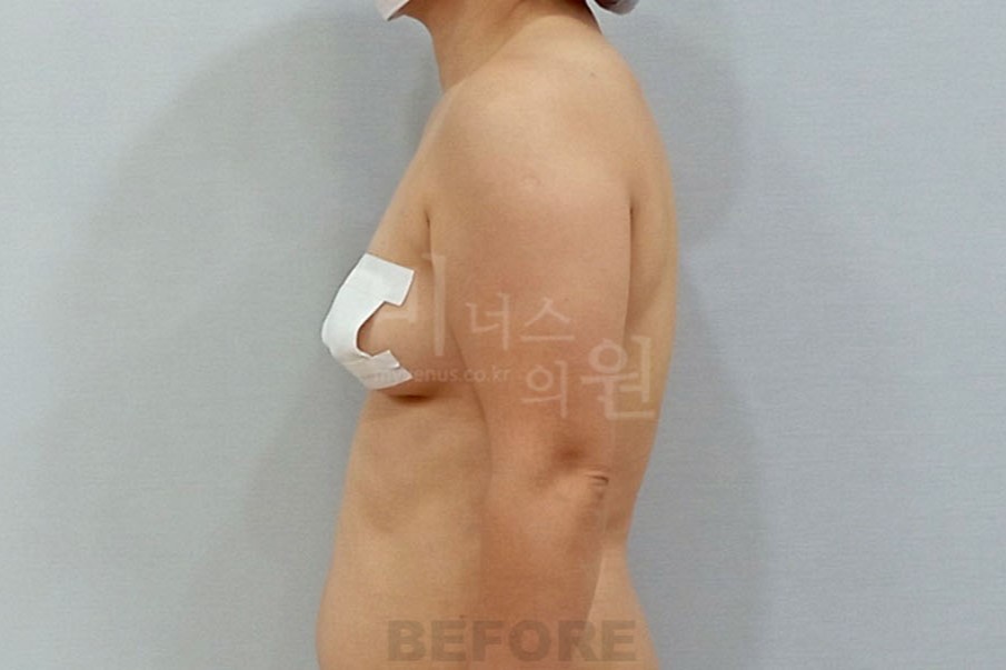 팔지방흡입_1 (2).JPG