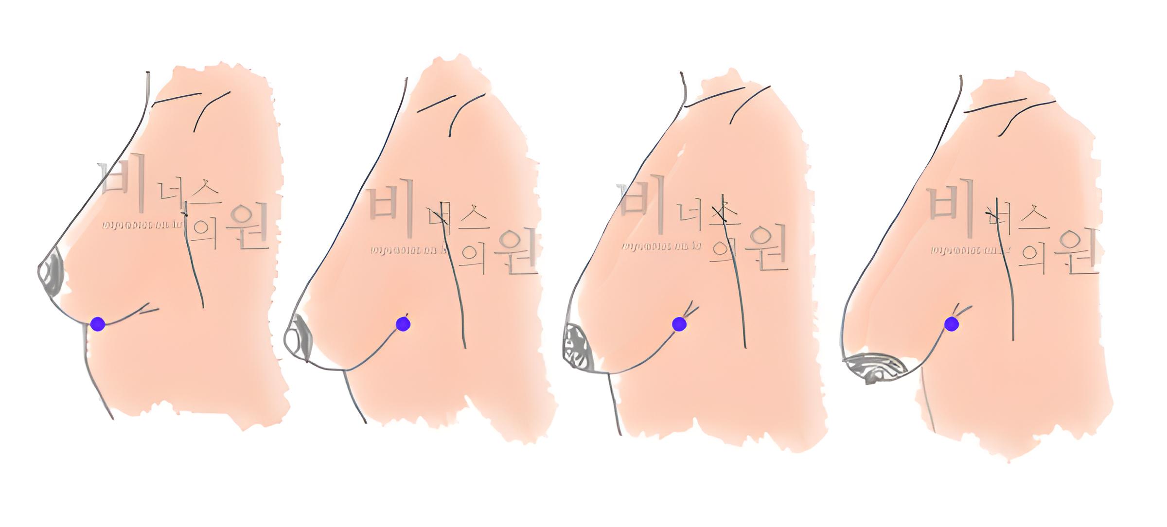 유방처짐 단계 구분을 보여주는 참고 그림(측면), 유두와 유방하주름 위치 비교 비너스의원