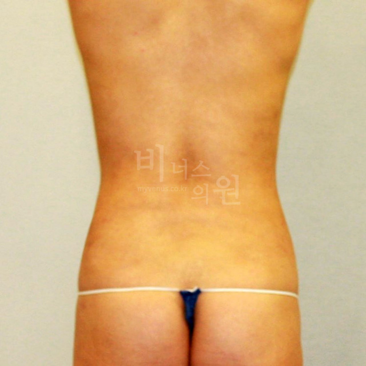 복부 지방흡입 수술 전 후면 비너스의원
