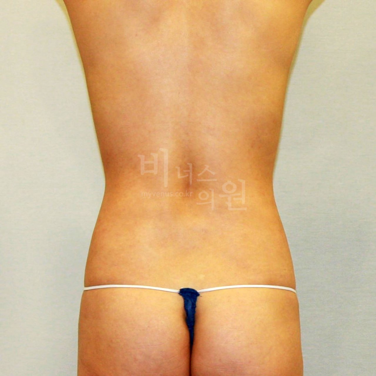 복부 지방흡입 수술 후 후면 비너스의원
