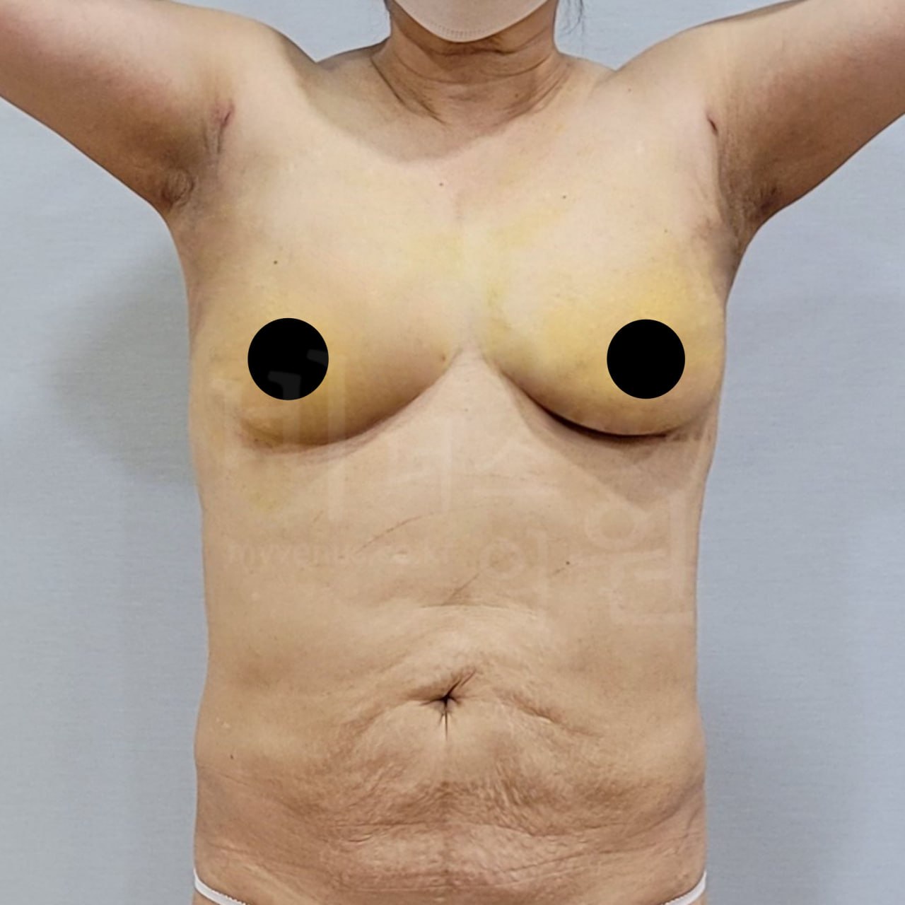 가슴축소 지방흡입 수술 후 정면 비너스의원