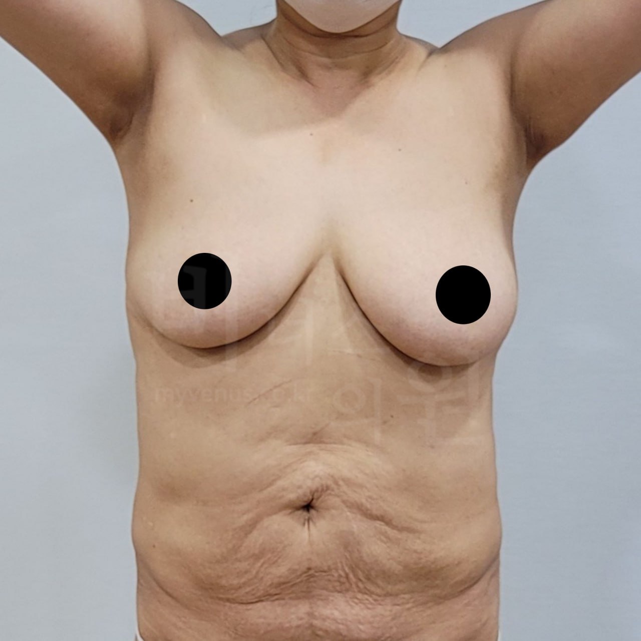 가슴축소 지방흡입 수술 전 정면 비너스의원