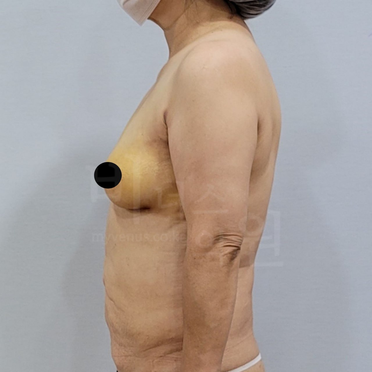 가슴축소 지방흡입 수술 후 측면 비너스의원