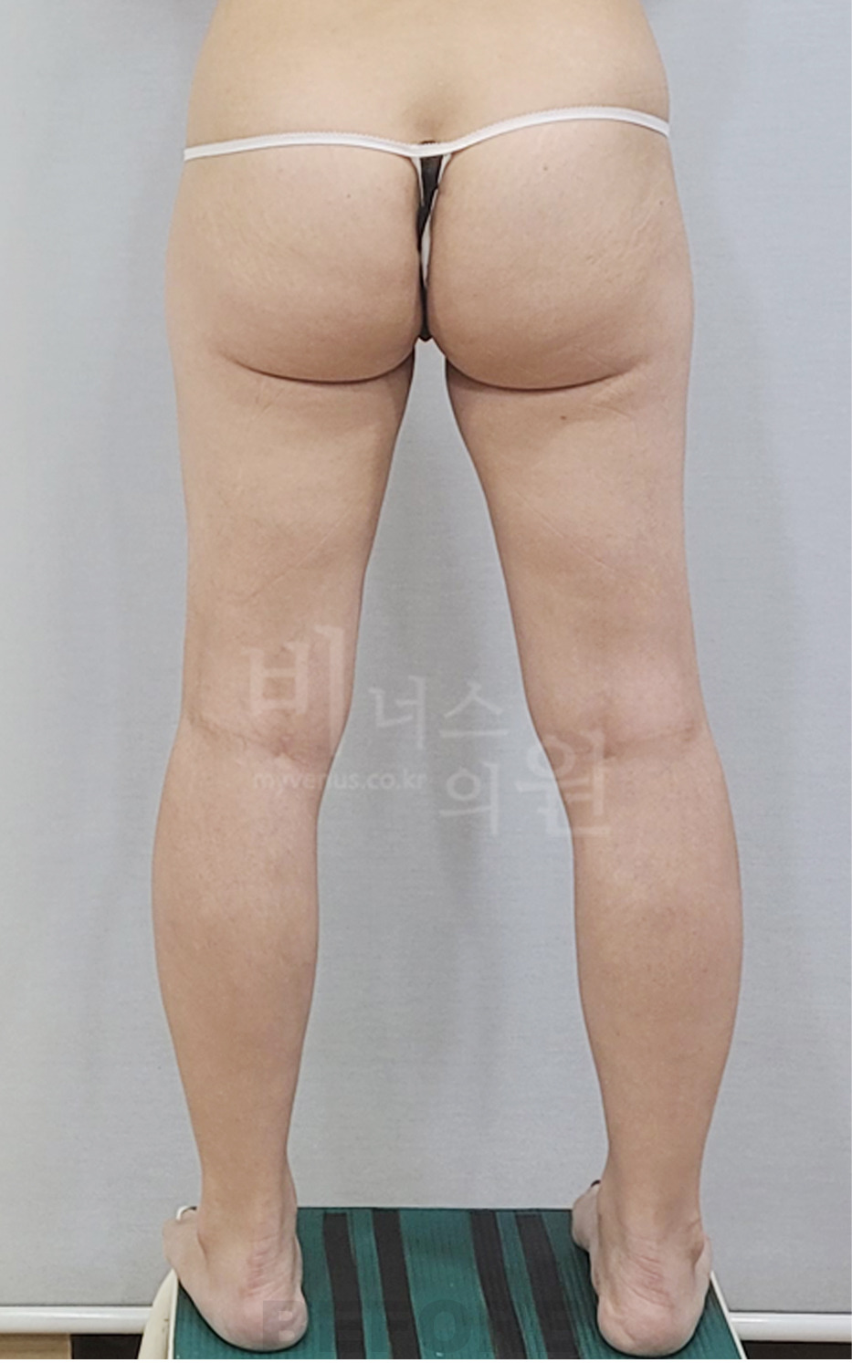 엉덩이 지방흡입 수술 전 후면(다리 간격을 벌린 컷) 비너스의원