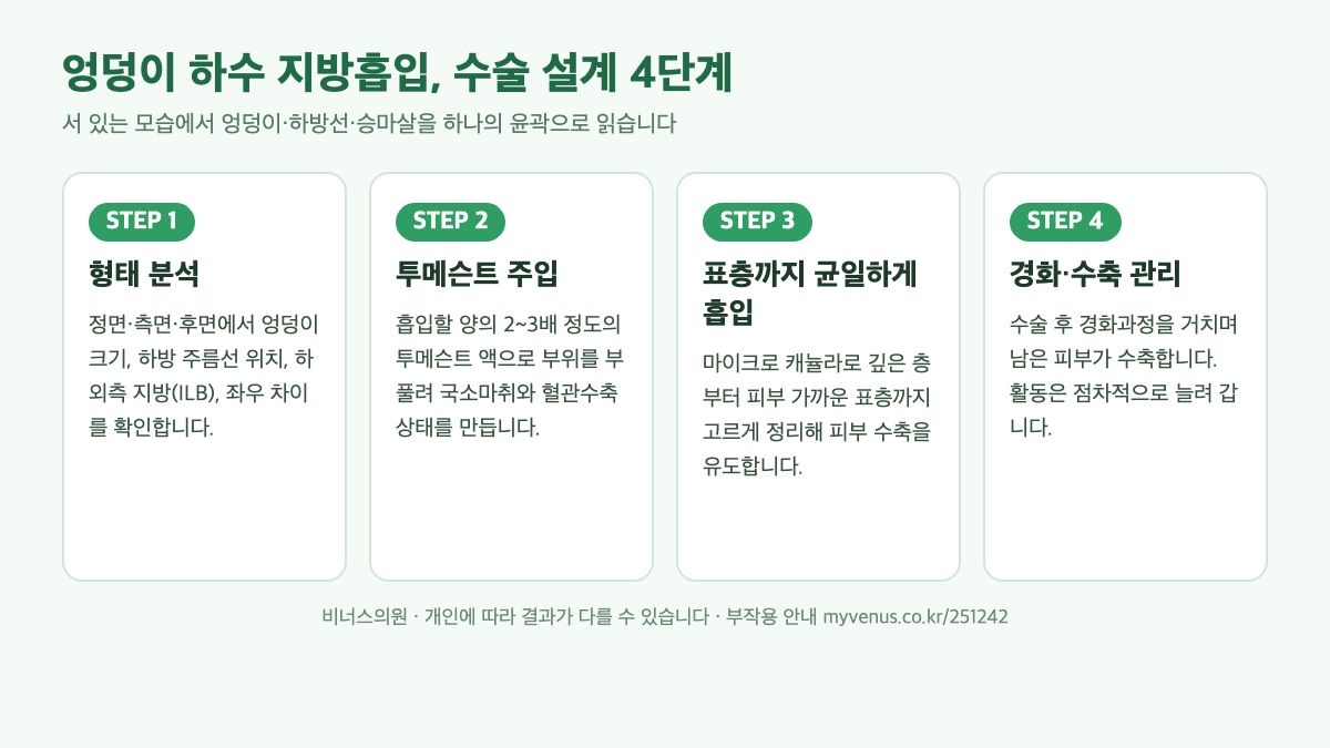 엉덩이하수 지방흡입 수술 설계 4단계 인포그래픽 — 형태 분석, 투메슨트 주입, 표층 흡입, 경화·수축 관리 단계