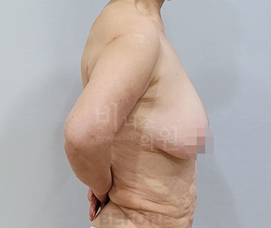 유방 지방흡입 수술 전 측면 비너스의원