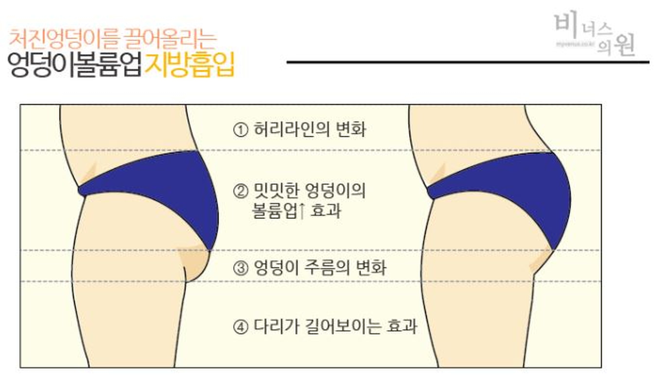 비너스의원 엉덩이볼륨업 지방이식 안내