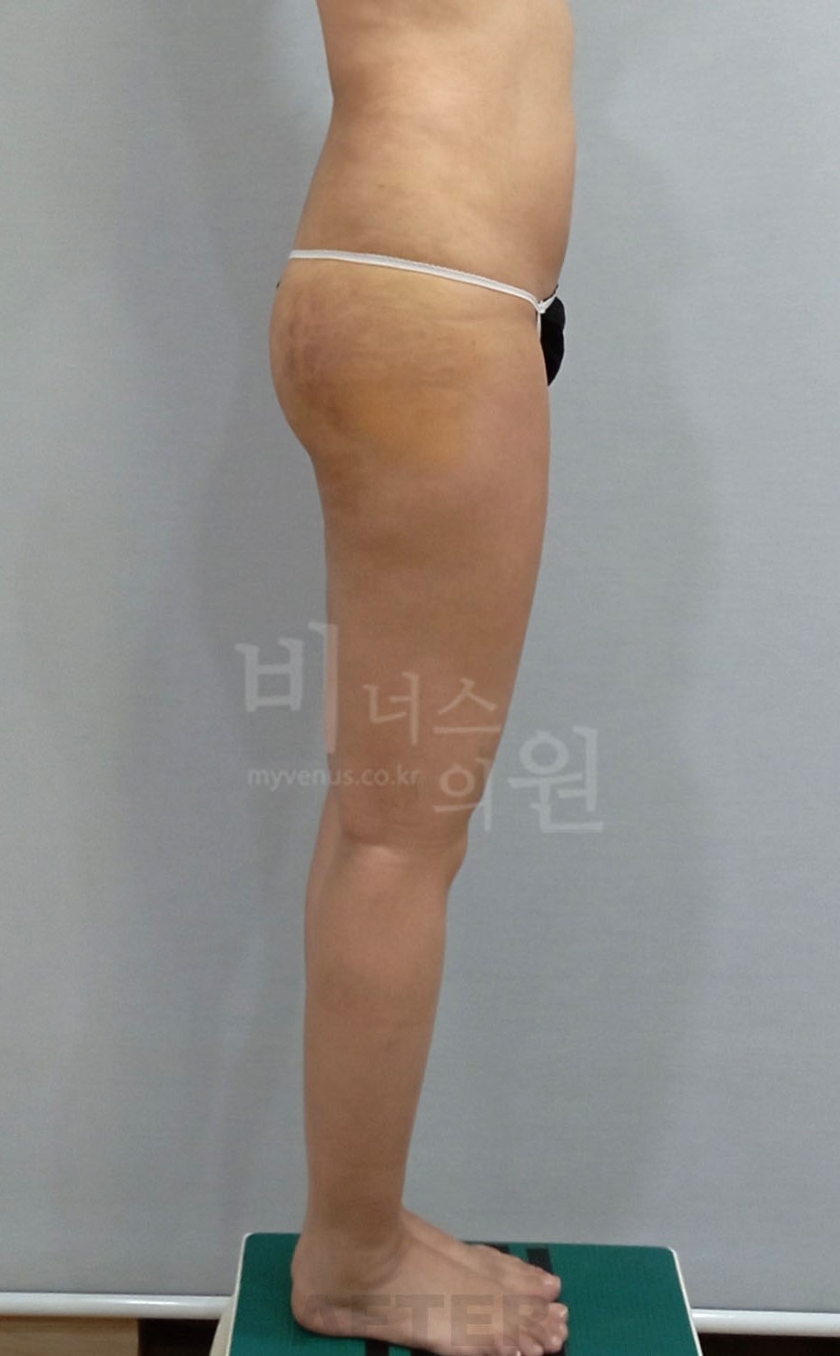 엉덩이전체·힙 지방흡입 수술 후 좌측면 비너스의원