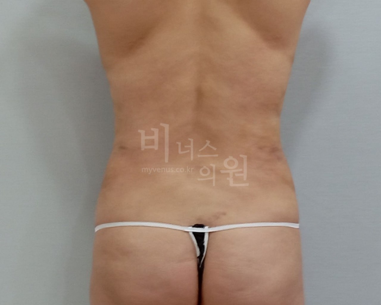 복부지방흡입 후면 수술 후
