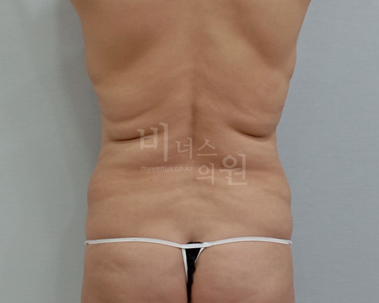 복부지방흡입 후면 수술 전