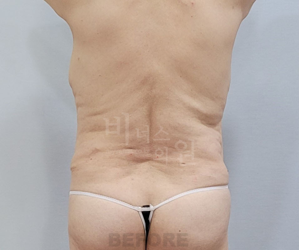 복부 지방흡입 수술 전 후면 비너스의원