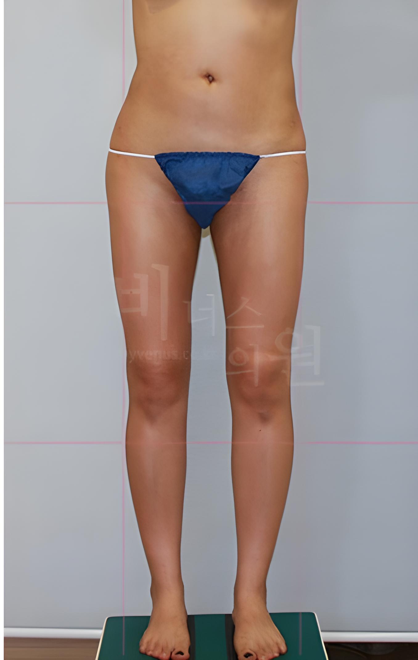 엉덩이축소 지방흡입 수술 후 정면 비너스의원
