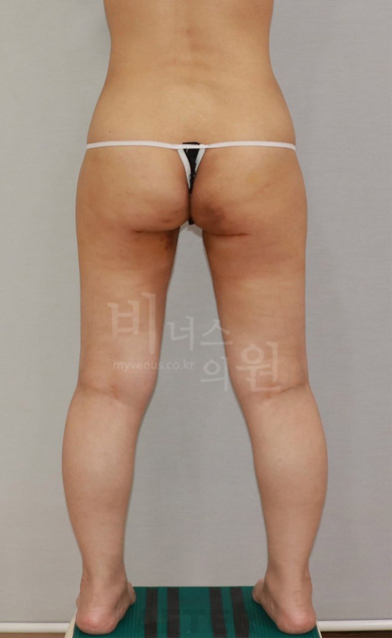 엉덩이 지방흡입 전후사진 후면 수술후 비너스의원