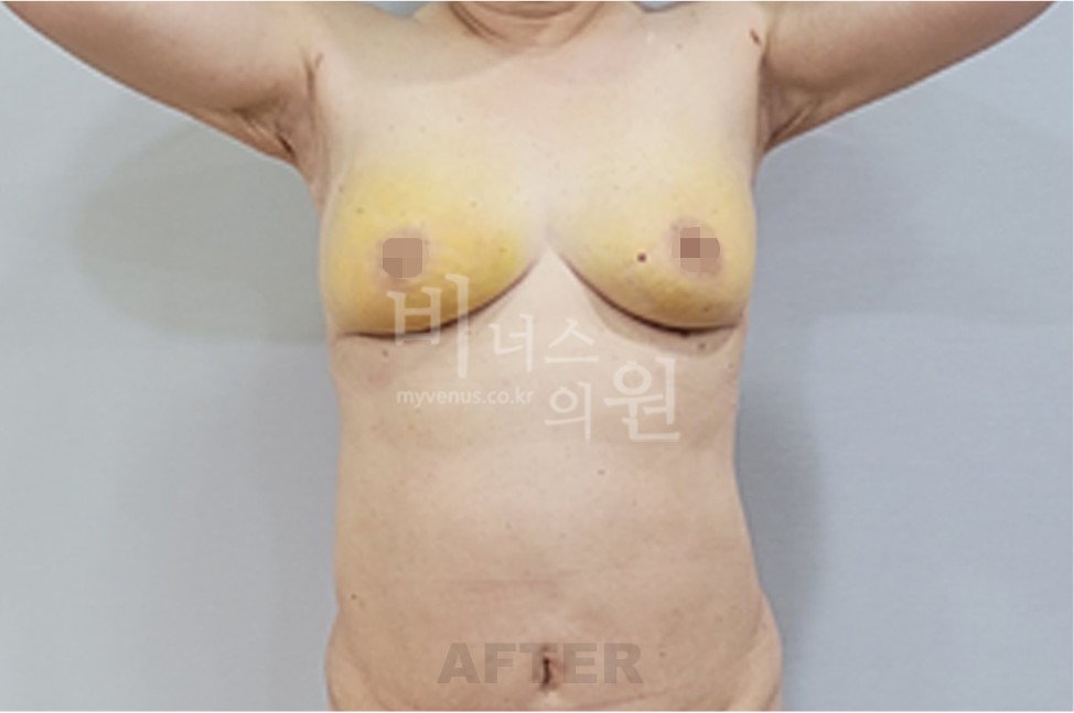 유방하수 표층 지방흡입 수술 후 정면 팔 올린 자세 비너스의원 전후사진