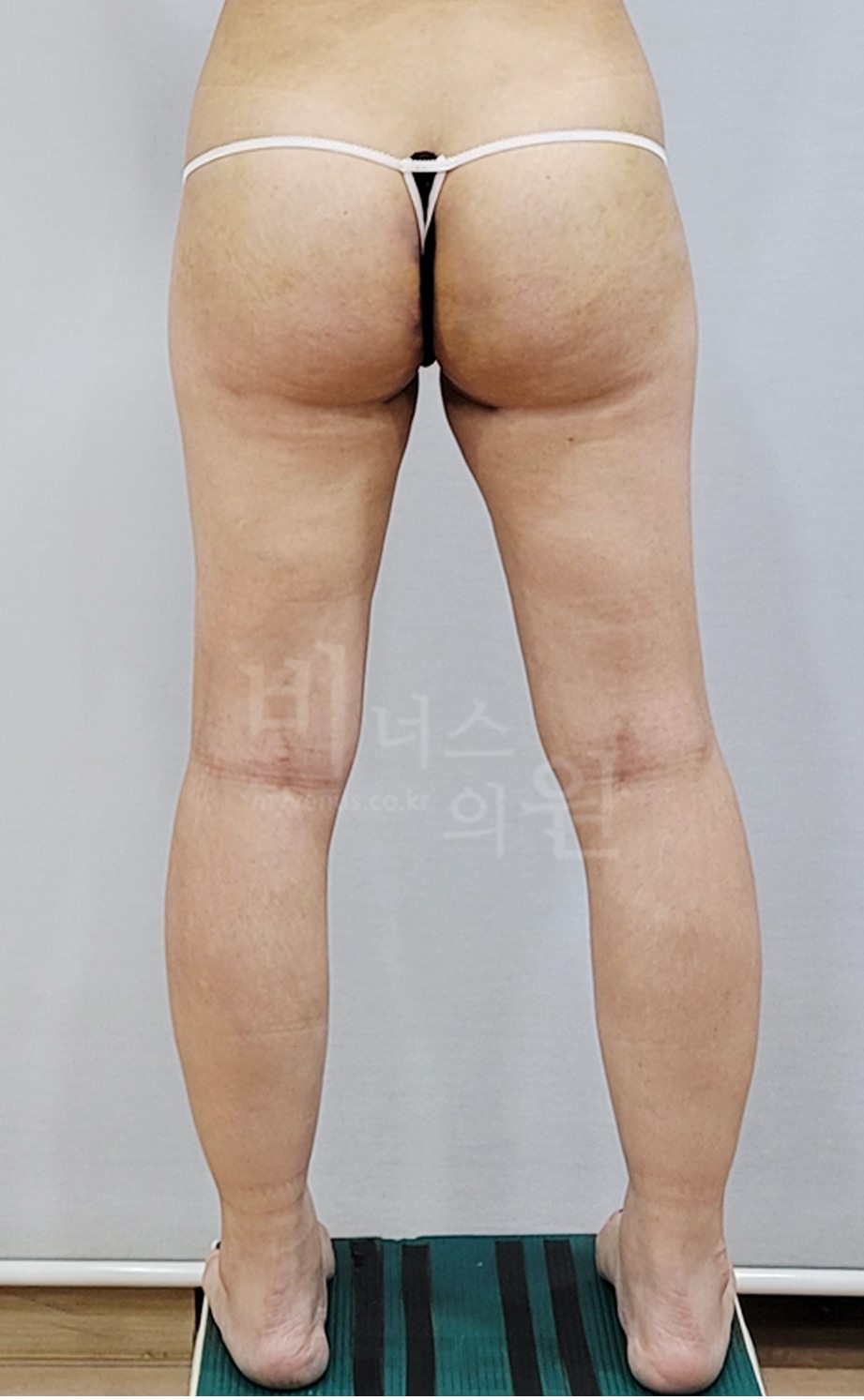 엉덩이축소 지방흡입 수술 후 다리를 벌린 후면 비너스의원