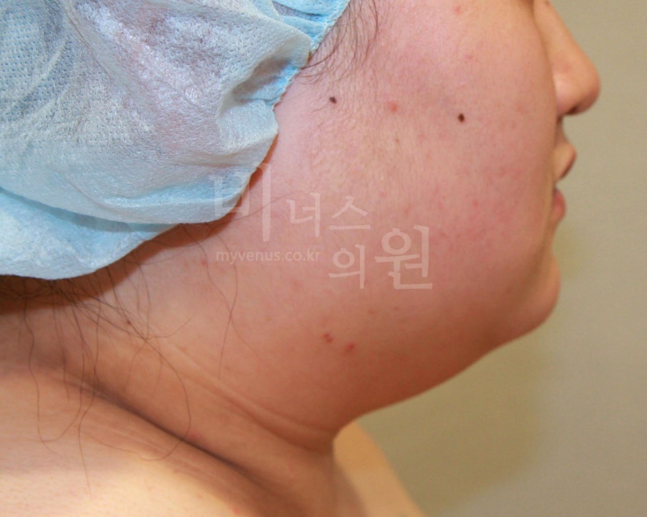 턱지방흡입 전 측면 비너스의원