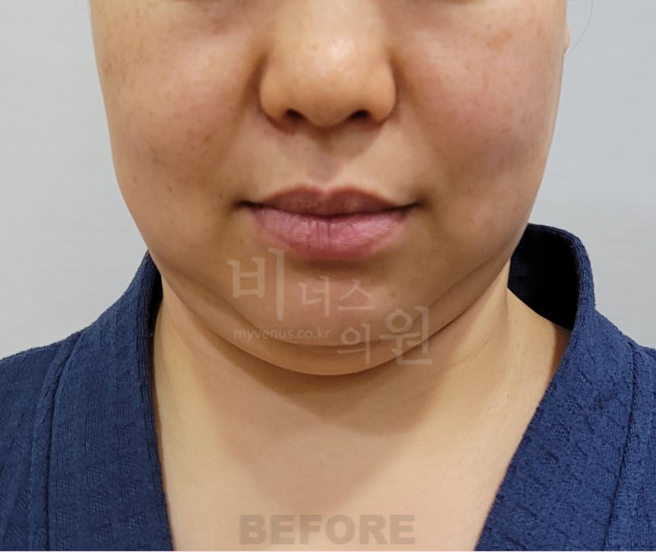 턱 지방흡입 수술 전 정면 비너스의원
