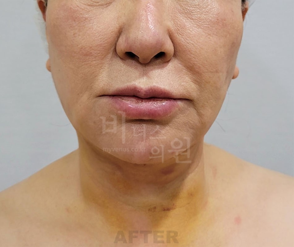 턱 지방흡입 수술 후 정면 비너스의원