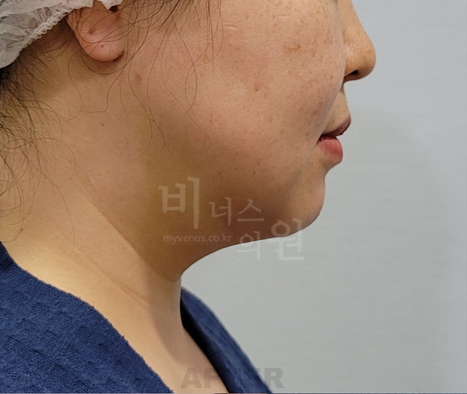 턱 지방흡입 수술 후 반대쪽 측면 비너스의원