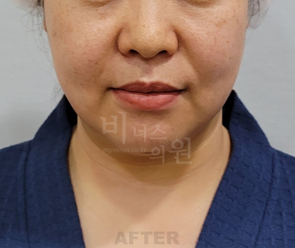 턱 지방흡입 수술 후 정면 비너스의원