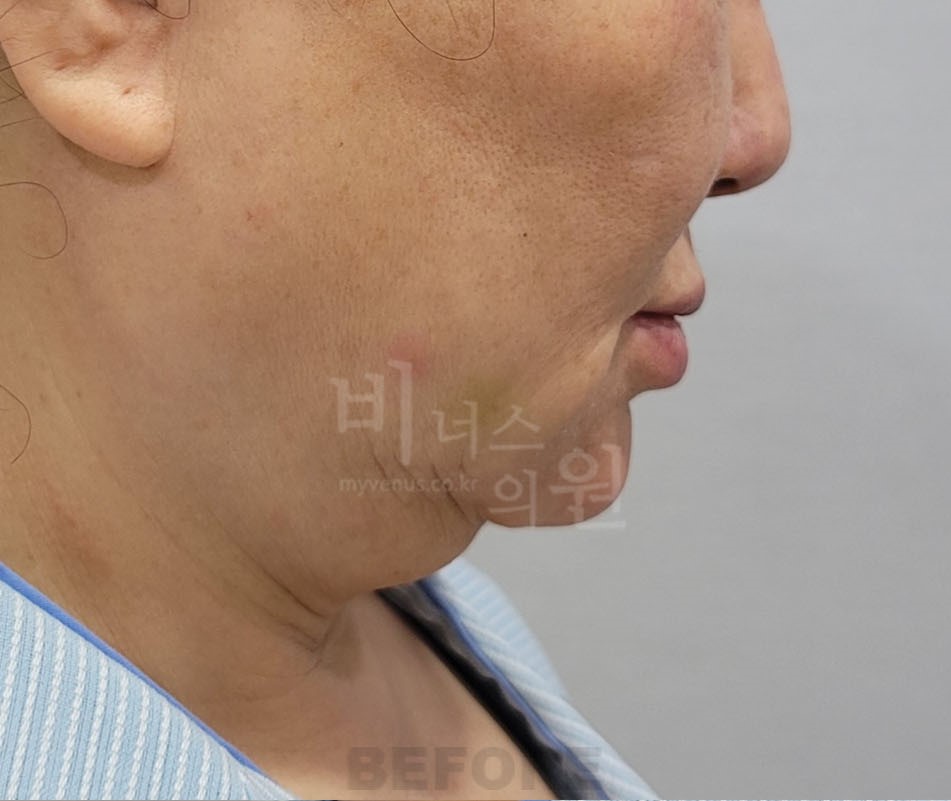 턱 지방흡입 수술 전 반대쪽 측면 비너스의원