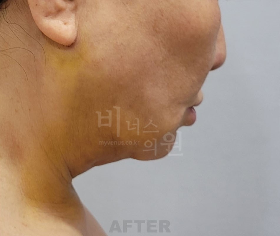 턱 지방흡입 수술 후 반대쪽 측면 비너스의원
