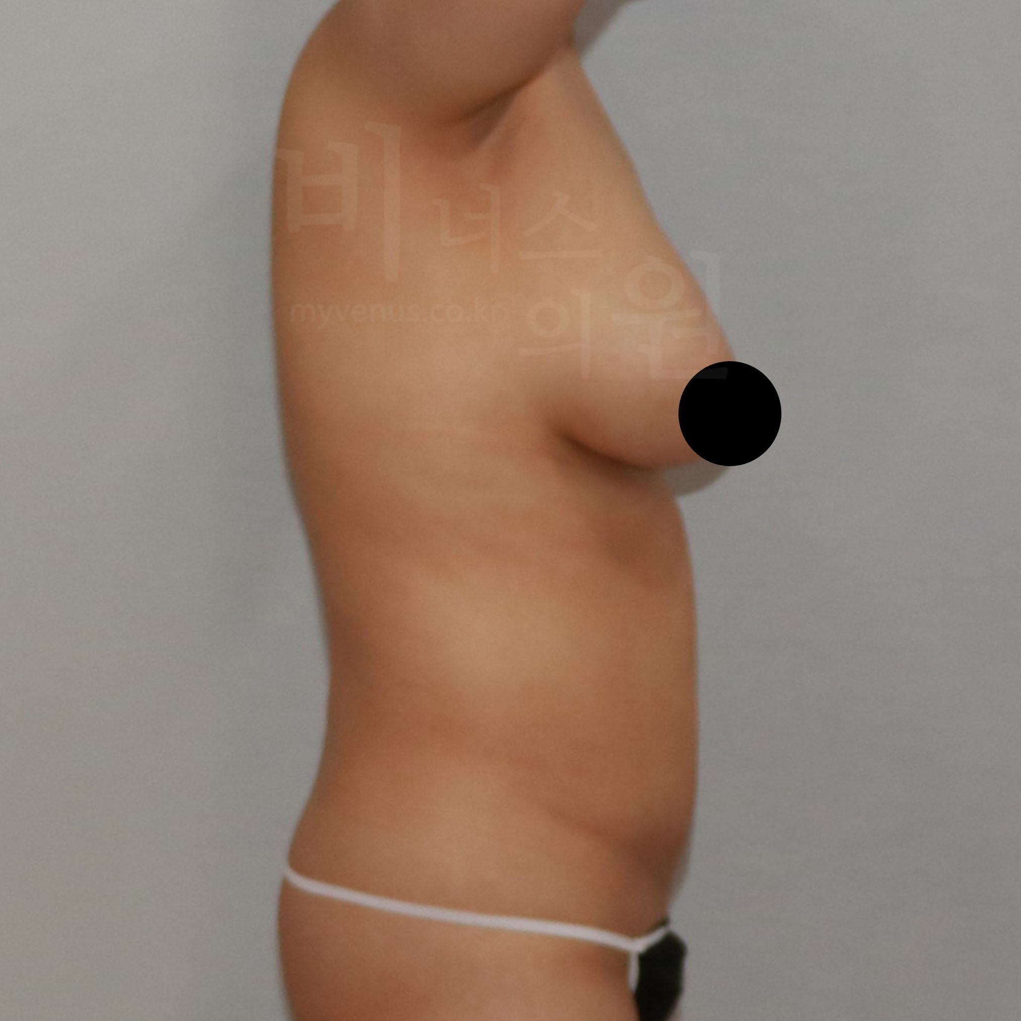 가슴축소 지방흡입 수술 전 측면 — 비너스의원 CASE3