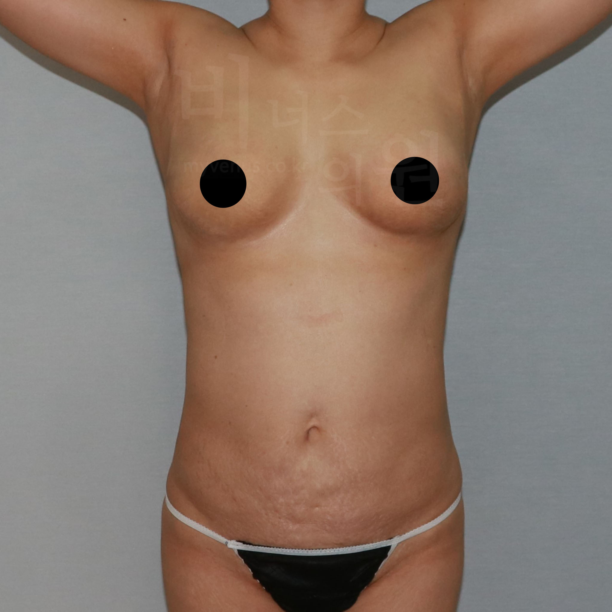 가슴축소 지방흡입 수술 후 정면 — 비너스의원 CASE2