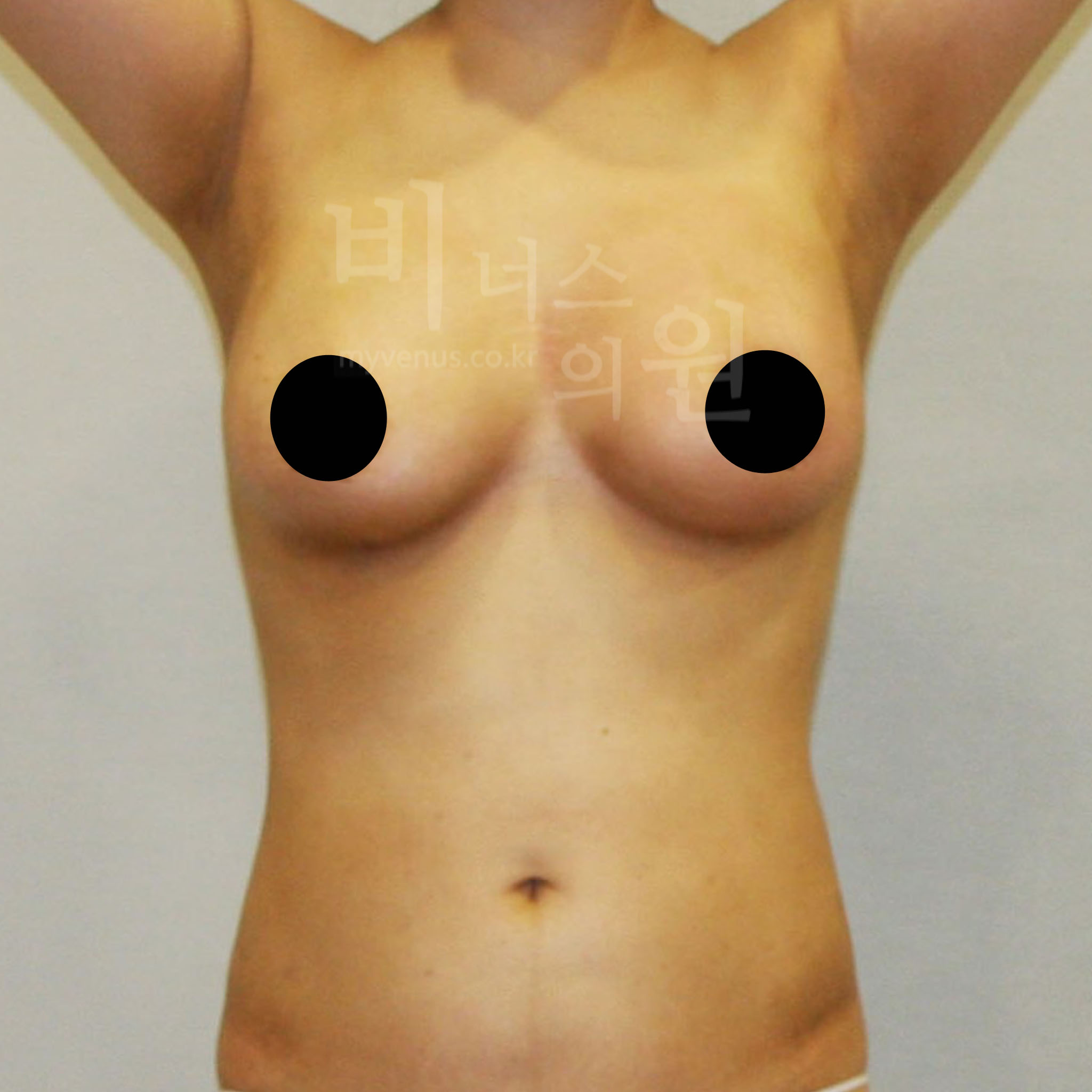 가슴축소 지방흡입 수술 후 정면 — 비너스의원 CASE1