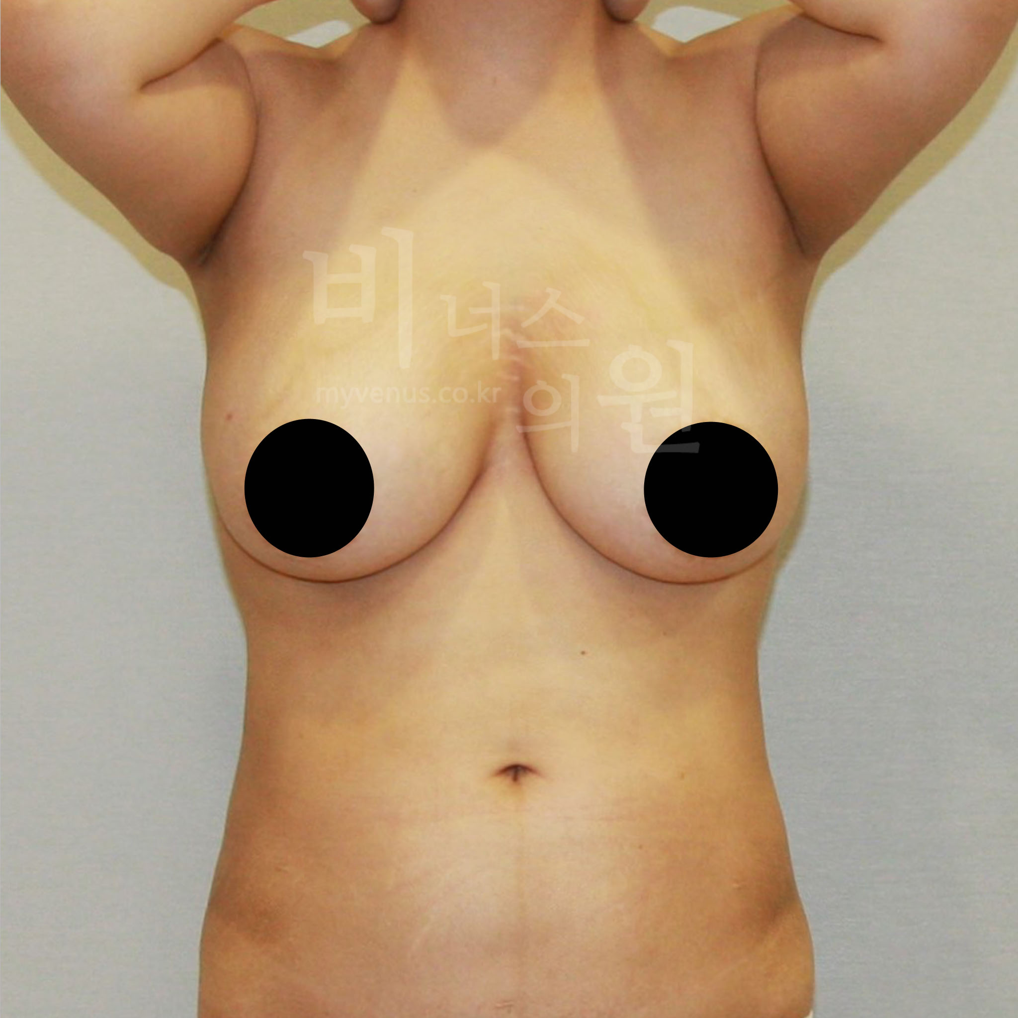 가슴축소 지방흡입 수술 전 정면 — 비너스의원 CASE1