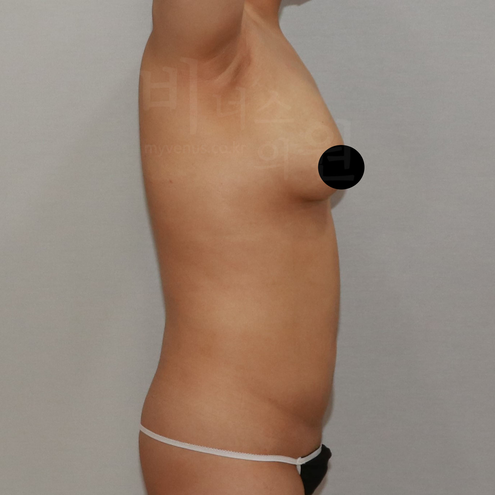 가슴축소 지방흡입 수술 후 측면 — 비너스의원 CASE3