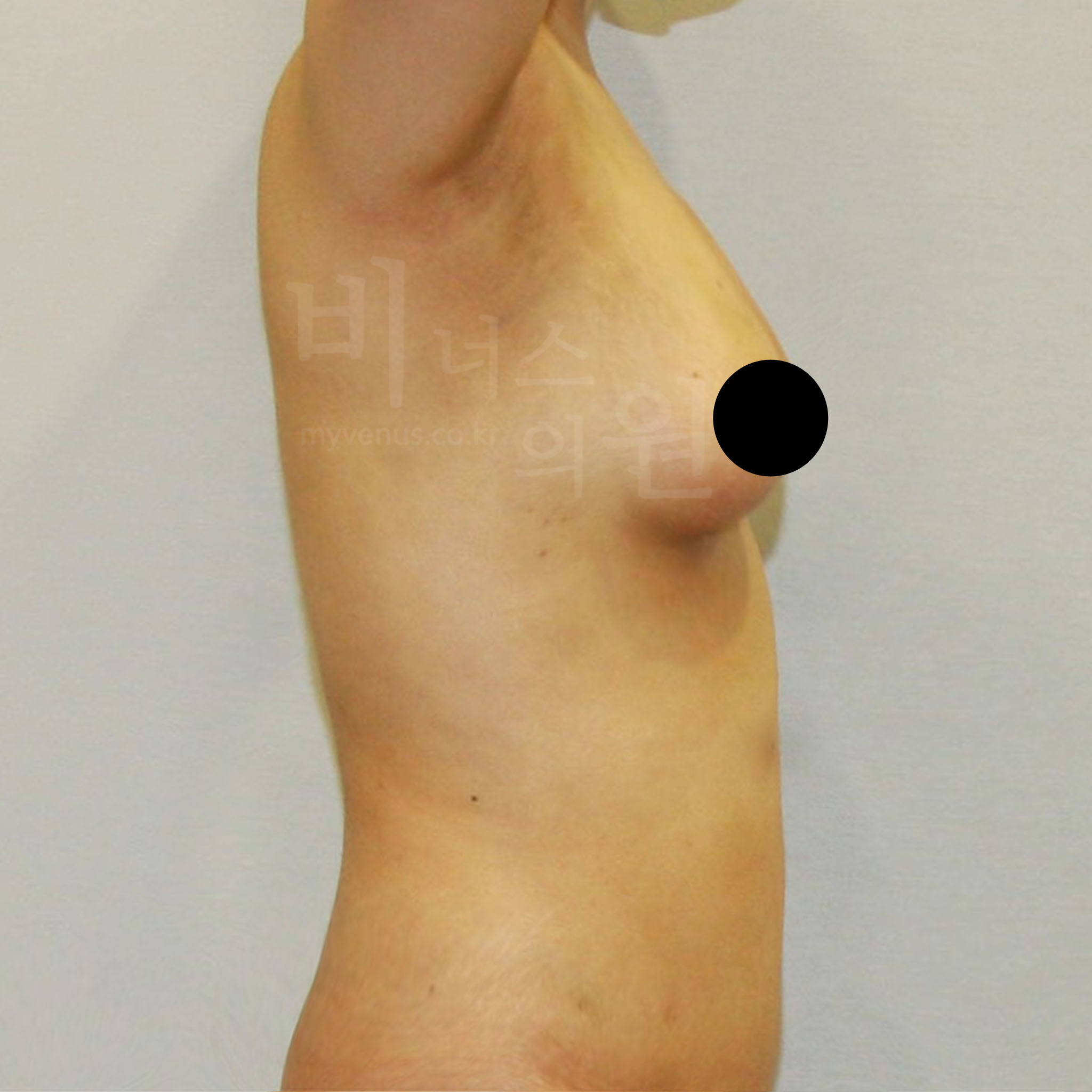가슴축소 지방흡입 수술 후 측면 — 비너스의원 CASE1