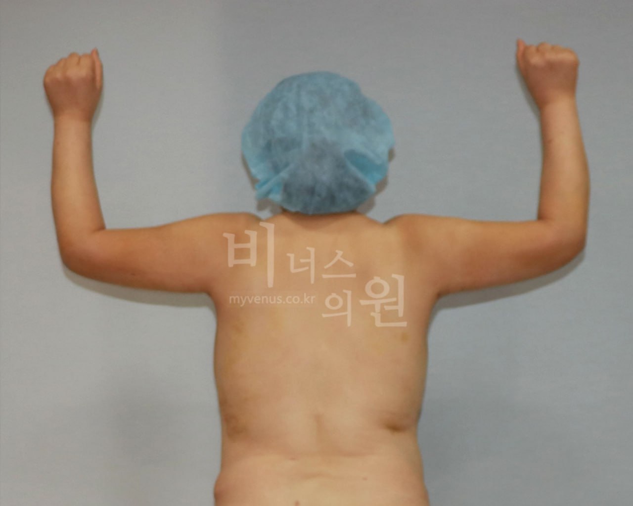 팔뚝 지방흡입 전후사진 후면 팔들기 수술후 비너스의원