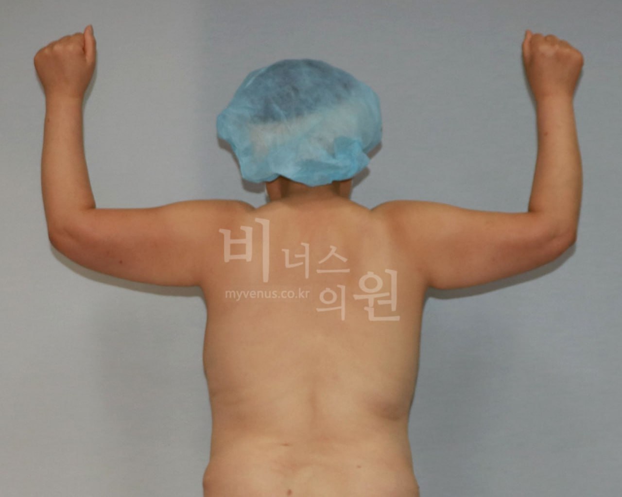 팔뚝 지방흡입 전후사진 후면 팔들기 수술전 비너스의원