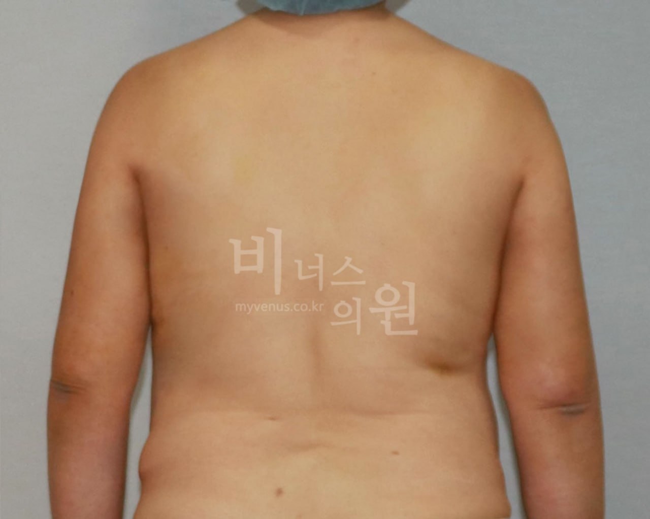 팔뚝 지방흡입 전후사진 후면 팔내림 수술후 비너스의원
