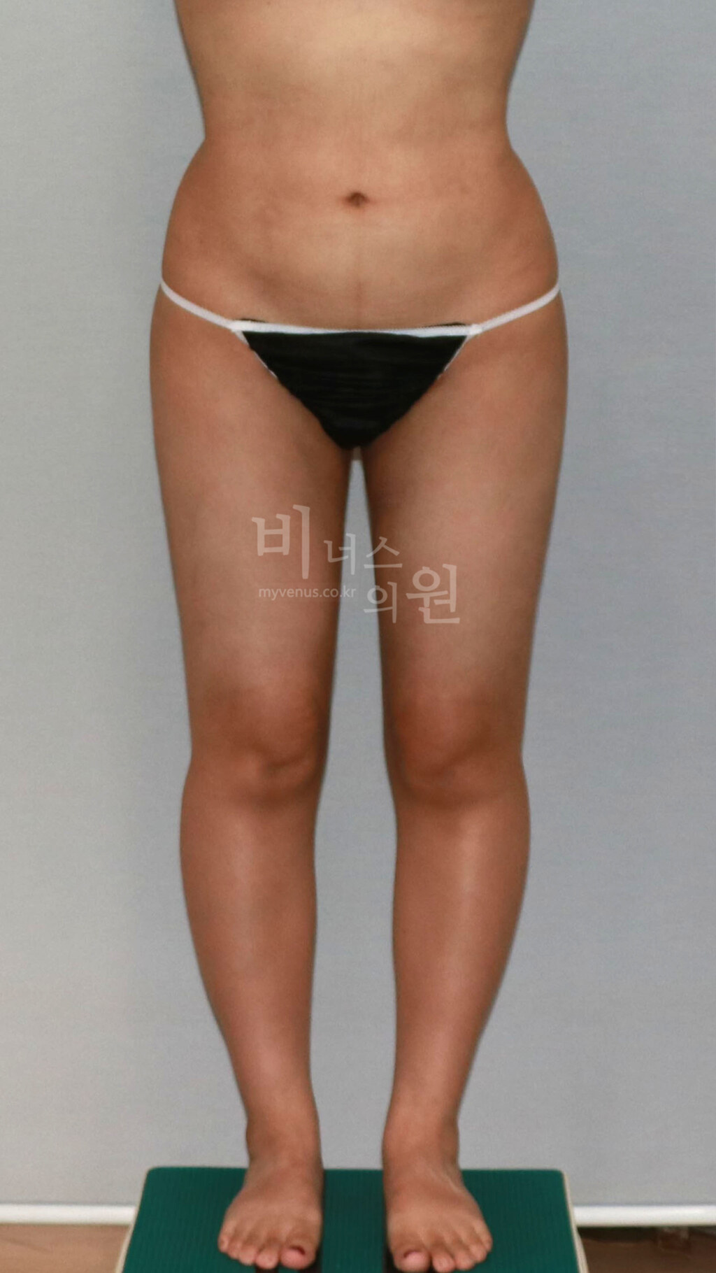 허벅지 지방흡입 수술 후 정면 비너스의원