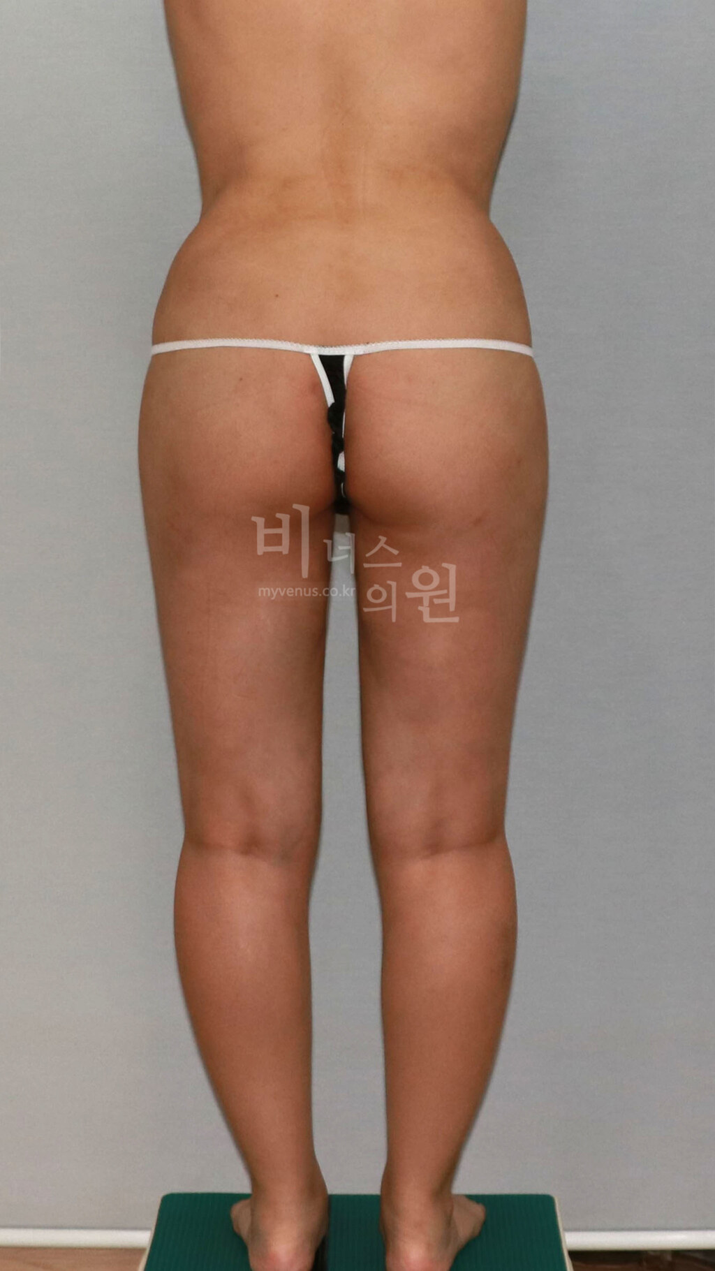 허벅지 지방흡입 수술 후 후면 비너스의원