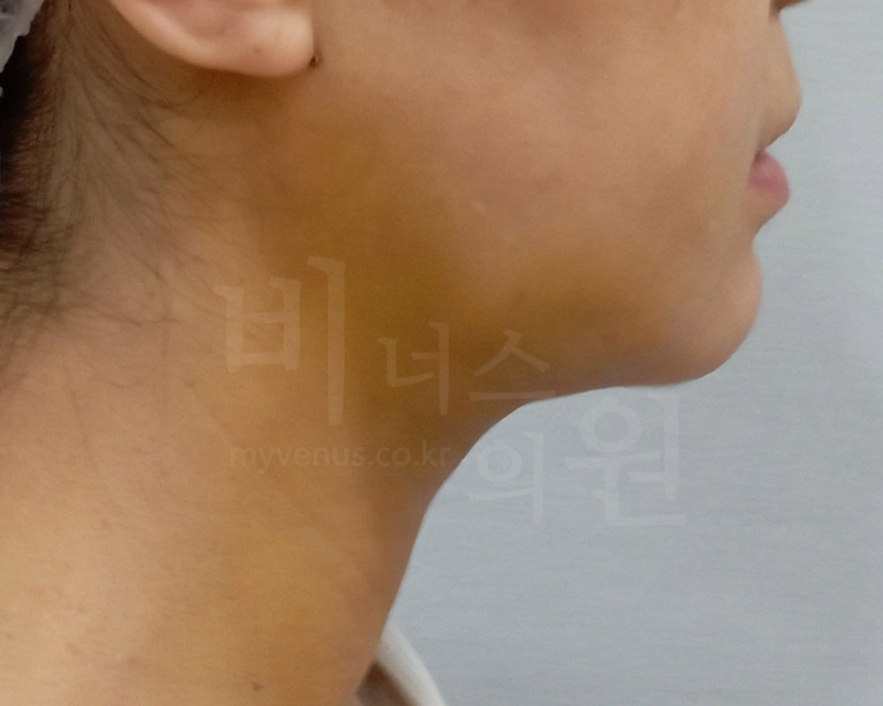 턱지방흡입 수술 후 왼측면 비너스의원