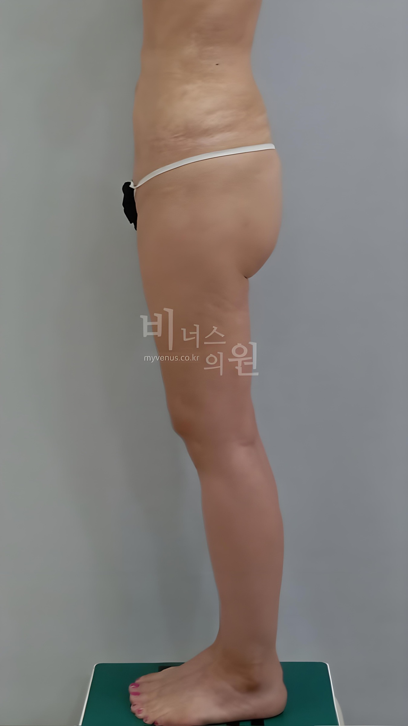 엉덩이 지방흡입 수술 전 우측면 비너스의원
