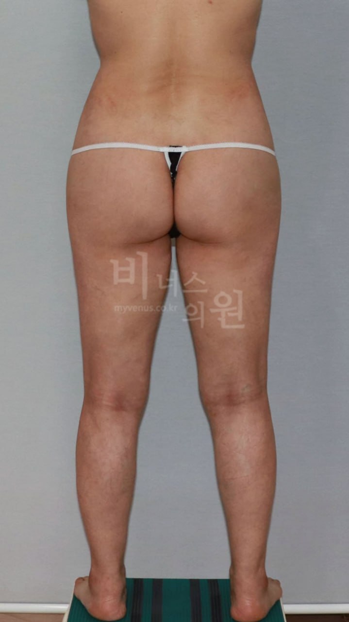 엉덩이 볼륨업 지방흡입 수술 후 정면 비너스의원